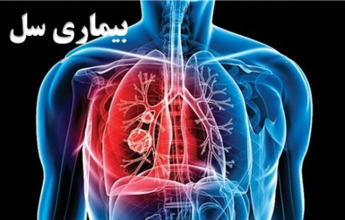 ۶۵۶۵ مبتلا به «سل» در کشور شناسایی شدند