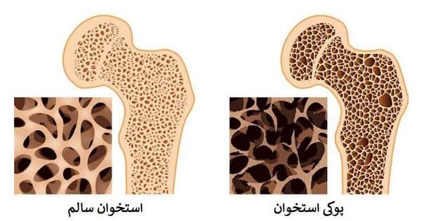 وقتی چهارستون بدن فرو می‌ریزد |  گزارش شهرآرانیوز از راهکار‌های مقابله با شیوع پوکی استخوان