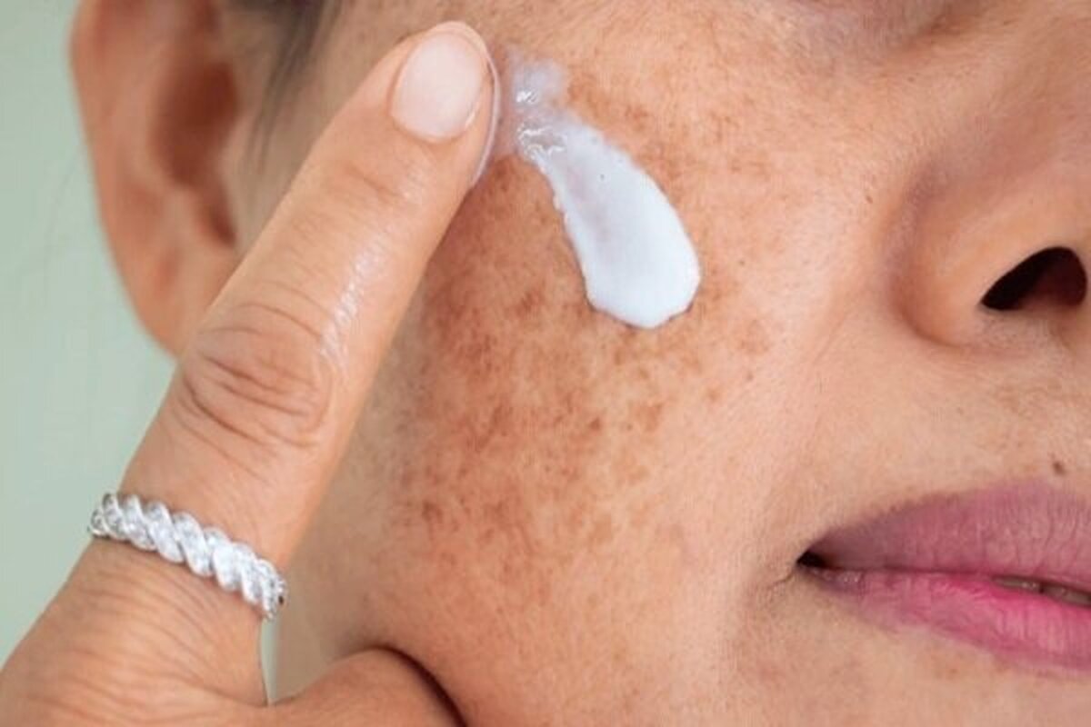 با منافذ باز پوست چه کنیم؟ | این منافذ به طور قطعی درمان می‌شوند؟