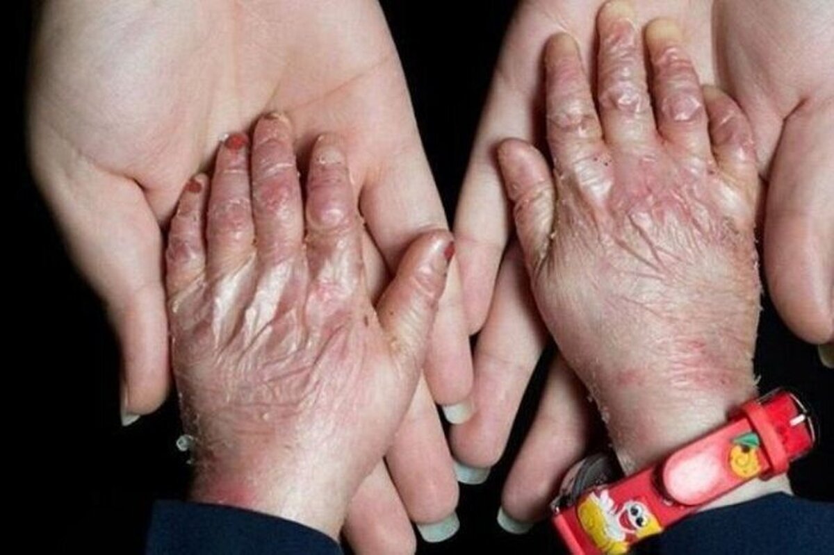 ۹۵ درصد بیماران پروانه‌ای حاصل ازدواج فامیلی هستند