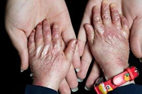 ۹۵ درصد بیماران پروانه‌ای حاصل ازدواج فامیلی هستند