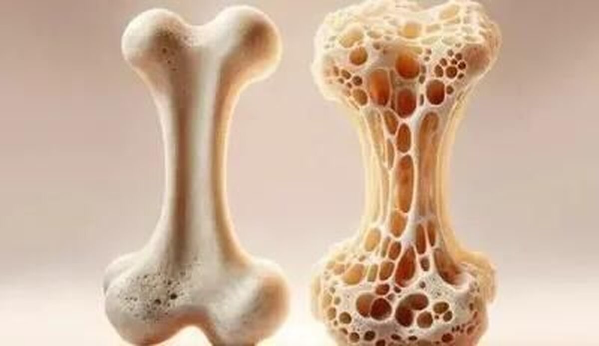 چه کسانی مستعد ابتلا به پوکی استخوان هستند؟