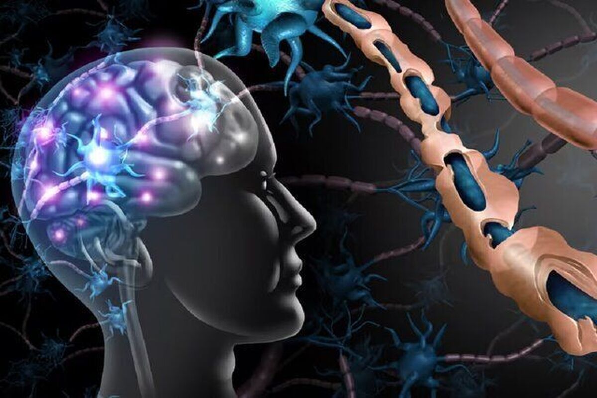 ابتلای زنان به بیماری‌ ام‌اس ۲ برابر مردان