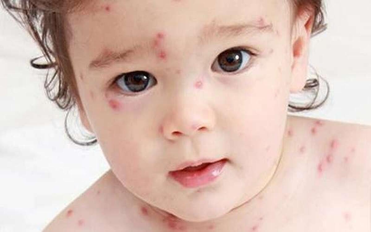 ایران در مرحله حذف سرخک و سرخجه | واکسیناسیون موثرترین راه کنترل بیماری‌های واگیر