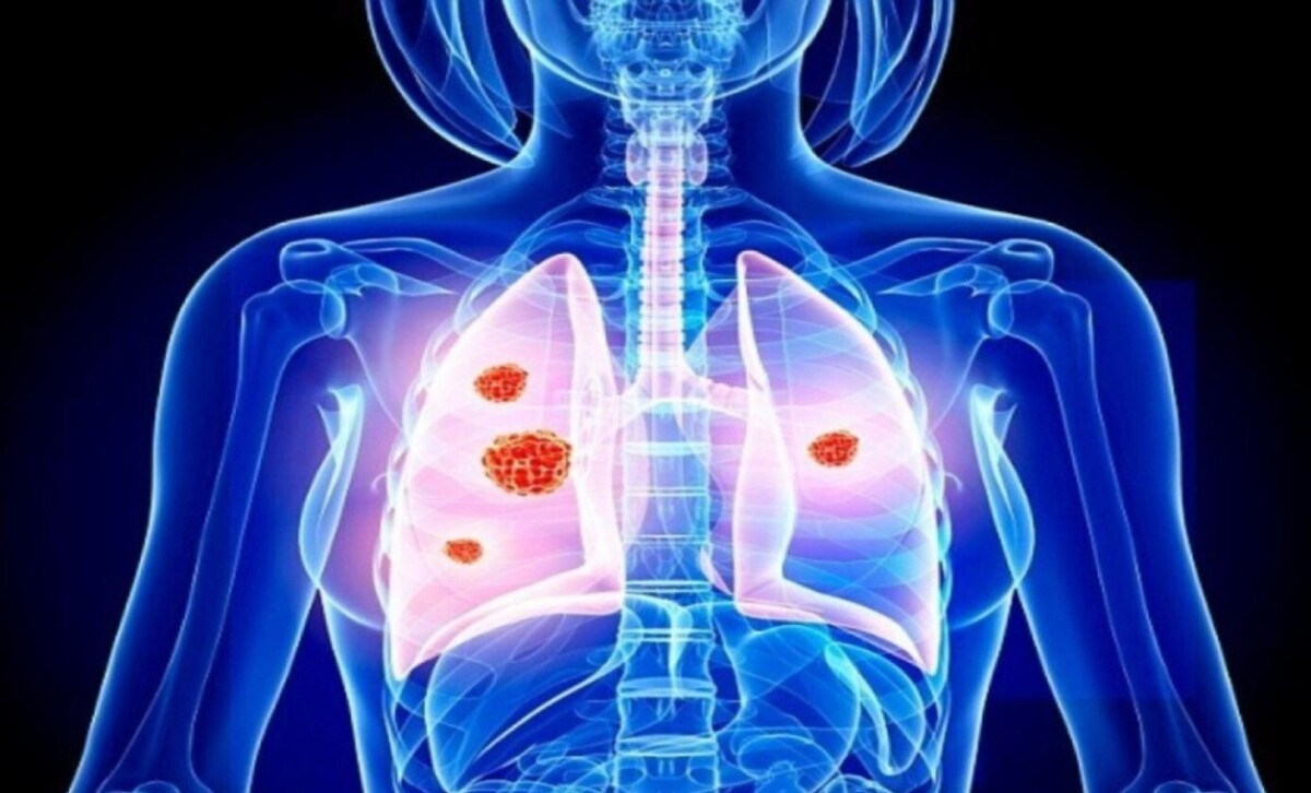 پنومونی از طریق عطسه و سرفه منتقل می‌شود | کودکان و سالمندان در معرض خطر نوع شدید بیماری