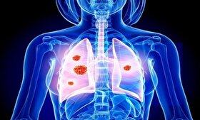 پنومونی از طریق عطسه و سرفه منتقل می‌شود | کودکان و سالمندان در معرض خطر نوع شدید بیماری