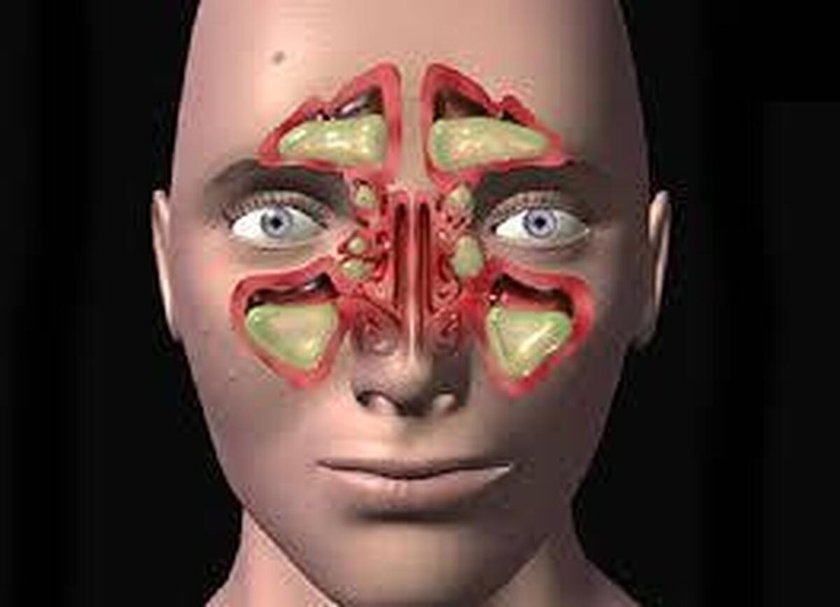 آلودگی هوا چگونه موجب تشدید سینوزیت مزمن می‌شود؟