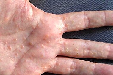 اینفوگرافی| چه کنیم اگزمای پاییزی نگیریم؟