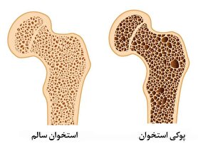 درباره استئوپروز چه می‌دانید؟ | شیوع نوعی پوکی استخوان در کودکان