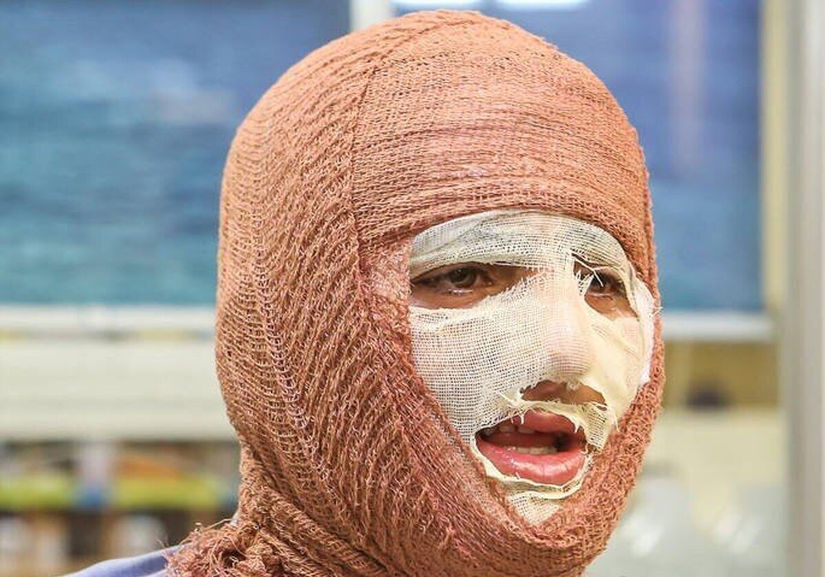 شناخت انواع سوختگی در حملات هوایی در شرایط جنگی