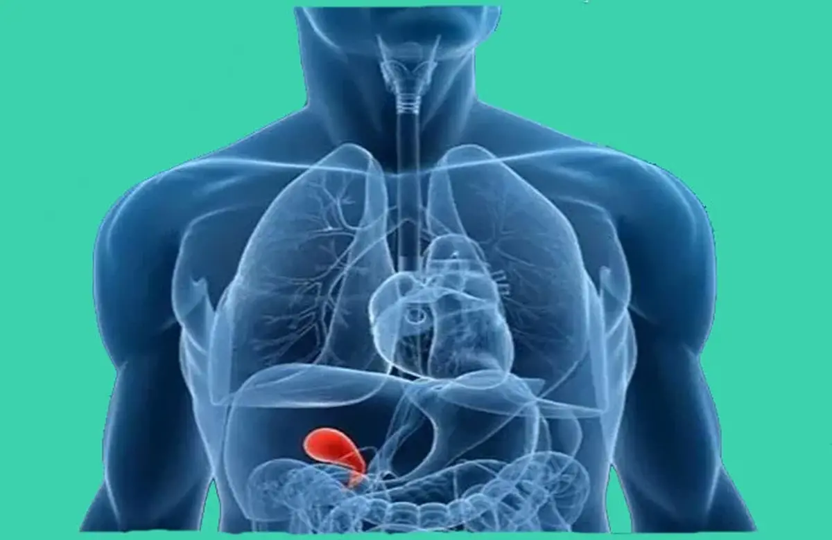 چه غذا&zwnj;هایی خطر سنگ صفرا را افزایش می&zwnj;دهند؟ | چگونه بفهمیم که سنگ کیسه صفرا داریم؟