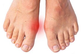 نادیده گرفتن درد شست پا می‌تواند به جراحی‌های پیچیده منجر شود