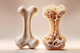 علائم پوکی استخوان چیست؟ | چه کسانی در معرض خطر ابتلا به پوکی استخوان هستند؟