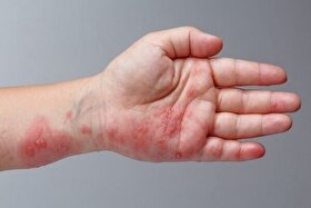 بیماری زونا چیست؟ | چه کسانی بیشتر در معرض ابتلا به بیماری زونا هستند؟