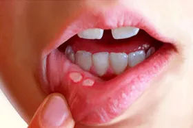 چرا دهانمان دائما آفت می&zwnj;زند؟