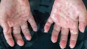 همه چیز درباره آبله میمونی + توصیه&zwnj;های وزارت بهداشت