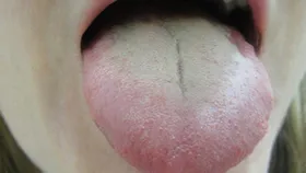 سفید شدن روی زبان خطرناک است؟