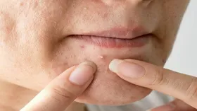 راهکار&zwnj;های جلوگیری از جوش صورت