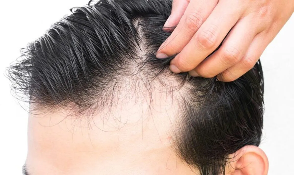 دلیل ریزش مو چیست؟