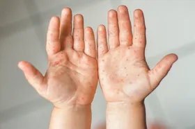 هشدار اورژانس درباره شیوع سرخک در عراق