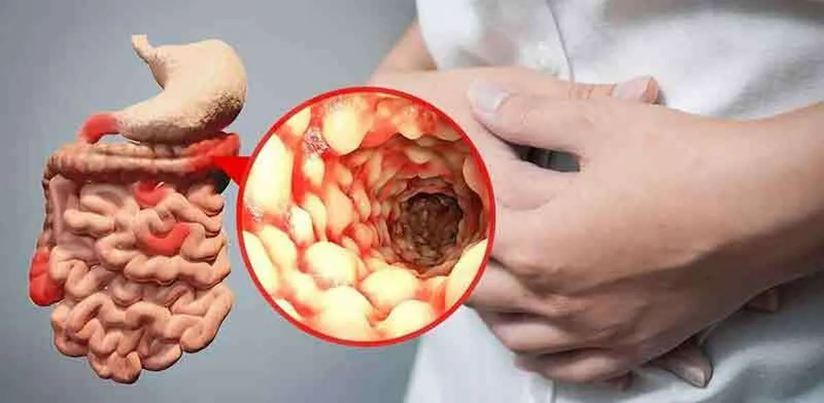 تفاوت درد آپاندیسیت و درد نفخ در چیست؟ | چه زمانی باید نگران شد؟