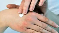 نسخه خانگی برای حفظ سلامت پوست در فصل زمستان