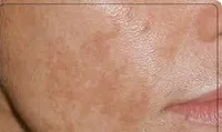 تازه‌ترین توصیه‌های پزشکی برای کنترل لک‌های پوستی