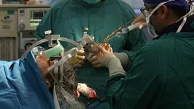 حذف تومور&zwnj;های مغزی با استفاده از دستگاه نوروناویگیشن ساخت متخصصان ایرانی برای اولین بار در مشهد