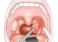 در مورد سنگ لوزه و دردسرهایش چه می دانید؟