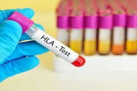 افزایش بانک اطلاعاتی HLA در کشور ضروری است