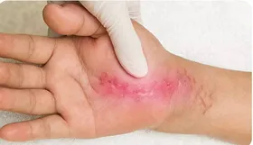 چگونه بدن شما زخم&zwnj;ها را ترمیم می&zwnj;کند؟