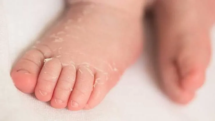 کاوازاکی چیست؛ همه چیز درباره این بیماری و ارتباطش با کرونا