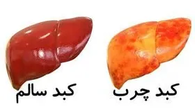 شیوع کبد چرب در ایران/۴۰ درصد ایرانی&zwnj;ها مبتلا به کبد چرب هستند