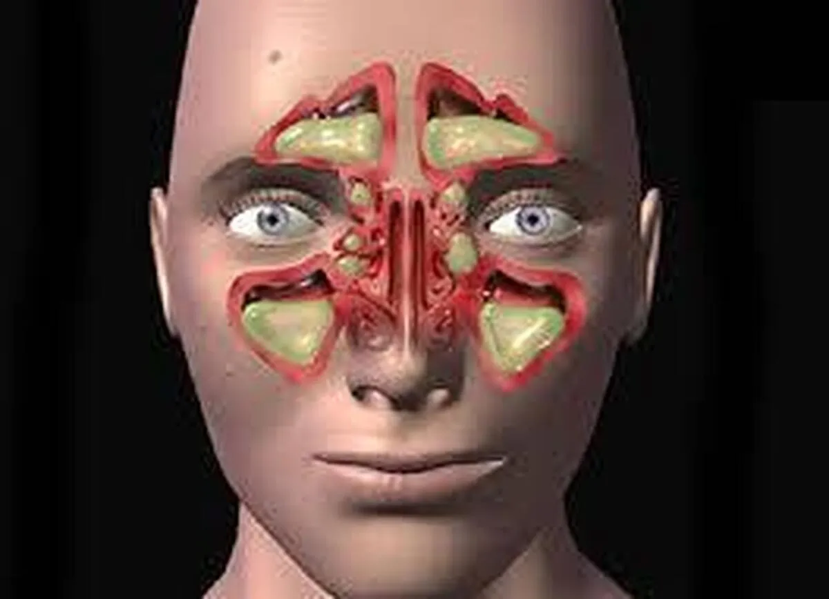 آلودگی هوا چگونه موجب تشدید سینوزیت مزمن می‌شود؟