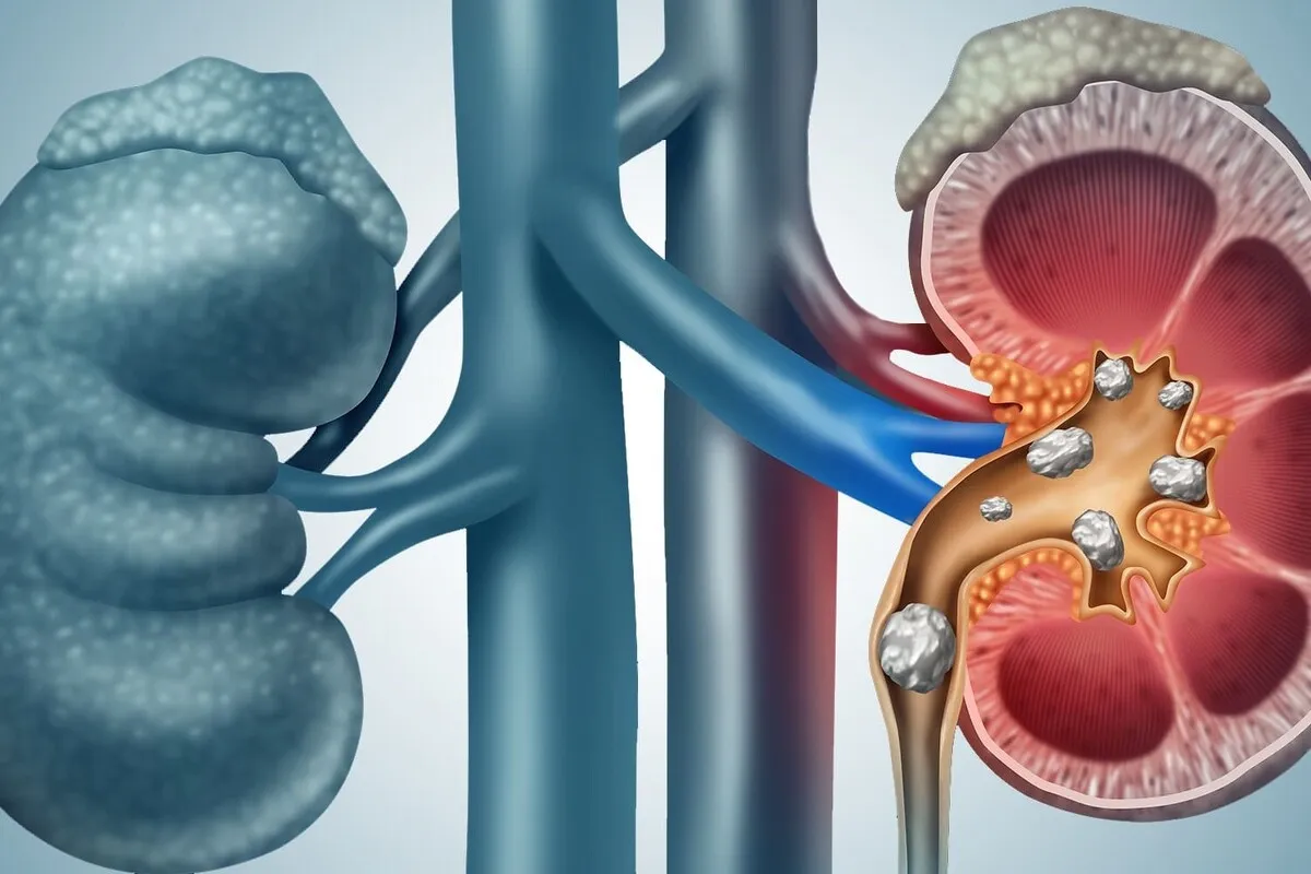 اینفوگرافی| چگونه از ایجاد سنگ کلیه پیشگیری کنیم؟