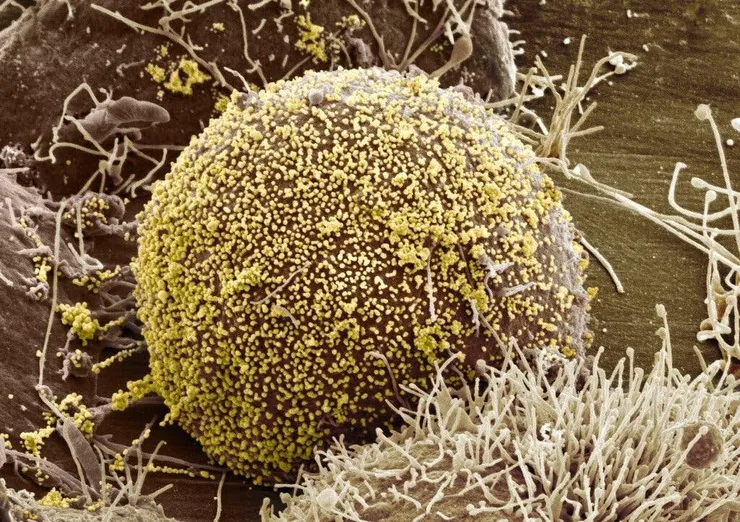 پزشکان برای اولین‌بار زنی مبتلا به HIV را با سلول‌های بنیادی درمان کردند