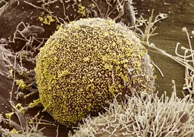 پزشکان برای اولین&zwnj;بار زنی مبتلا به HIV را با سلول&zwnj;های بنیادی درمان کردند
