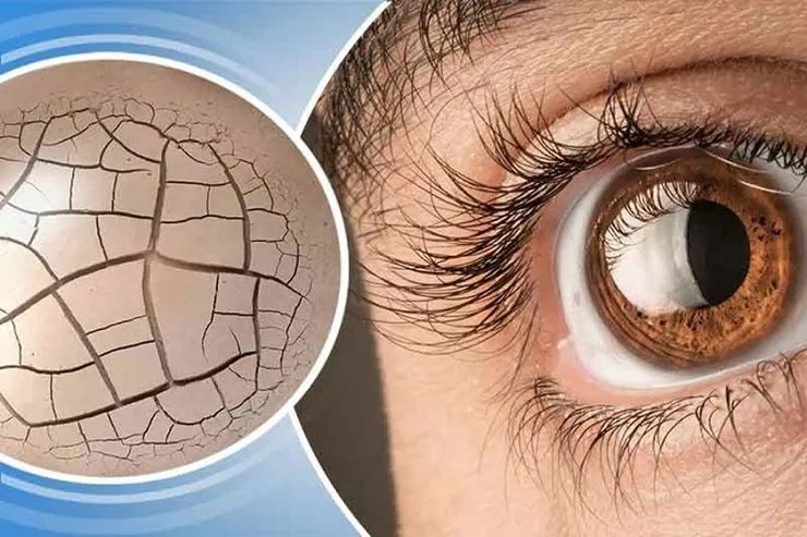۵ دارویی که مصرف آن‌ها، سبب خشکی چشم می‌شود