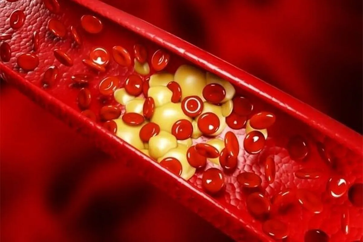 مهم‌ترین راهکار کنترل چربی خون را بشناسید