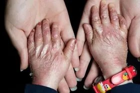۹۵ درصد بیماران پروانه&zwnj;ای حاصل ازدواج فامیلی هستند