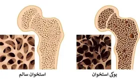 یائسگی زودرس، عامل مهم در ابتلای زنان به پوکی استخوان