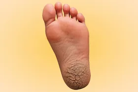 گسل&zwnj;های پوستی پاشنه | ترک پا نشانه&zwnj;ای آشکار از نیاز فوری پوست به مراقبت و درمان است