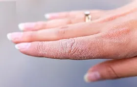 هفت ماده غذایی برای مقابله با خشکی پوست در فصل&zwnj;های سرد سال