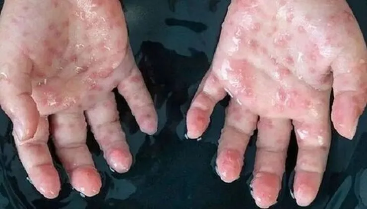 همه چیز درباره آبله میمونی + توصیه‌های وزارت بهداشت