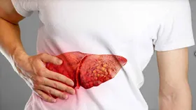 اینفوگرافی| ۱۰ نکته طلایی که بیماران مبتلا به کبد چرب باید بدانند