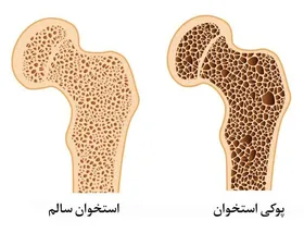 درباره استئوپروز چه می&zwnj;دانید؟ | شیوع نوعی پوکی استخوان در کودکان