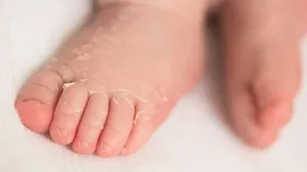 کاوازاکی چیست؛ همه چیز درباره این بیماری و ارتباطش با کرونا