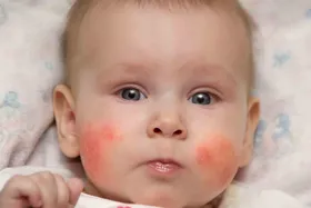 از نشانه&zwnj;های آلرژی غیرغذایی کودکان چه می&zwnj;دانید؟