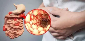 رفلاکس معده در روزه&zwnj;داری، پیامد پرخوری در وعده سحر