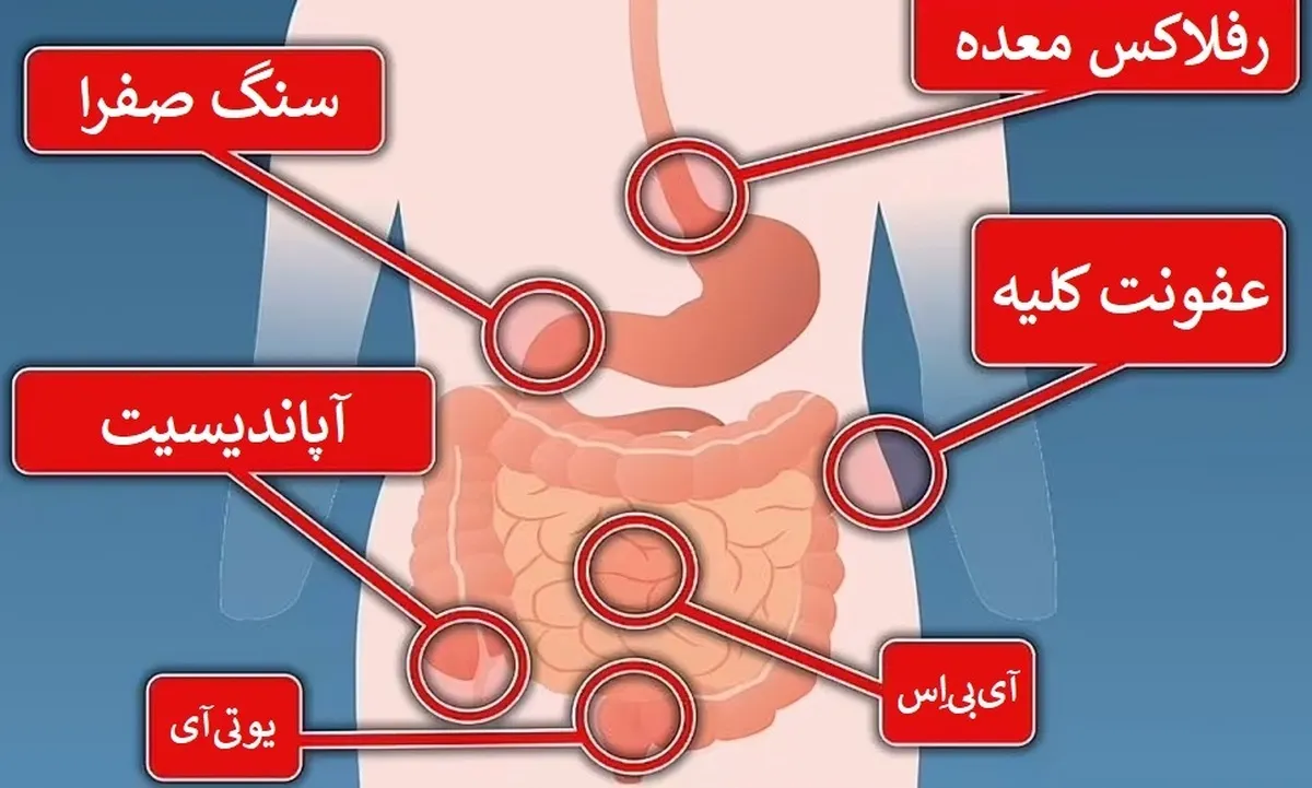 آشنایی با ۵ علت مهم درد شکم در زنان که باید جدی گرفته شوند
